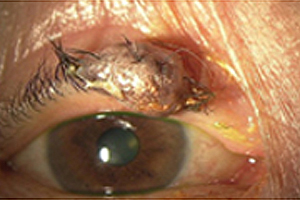 眼瞼腫瘍手術前
