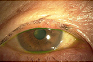 眼瞼腫瘍手術後